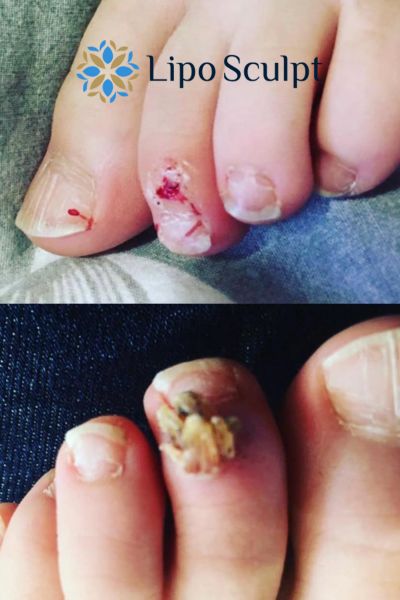 Wart removal customer results from Lipo Sculpt Poulton